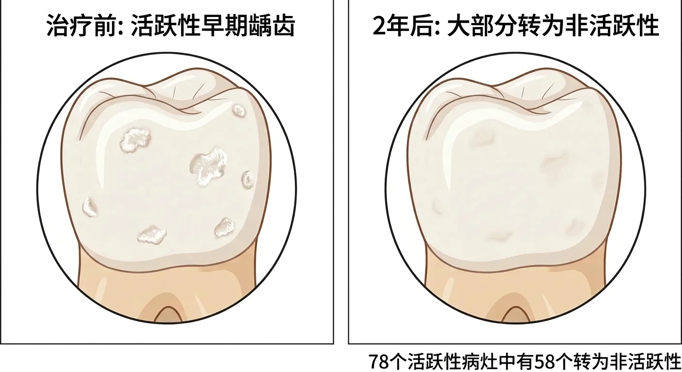 比较治疗前因活动性早期龋齿而布满多个白斑的牙齿，与2年后同一颗牙齿上大部分白斑已变淡的图示