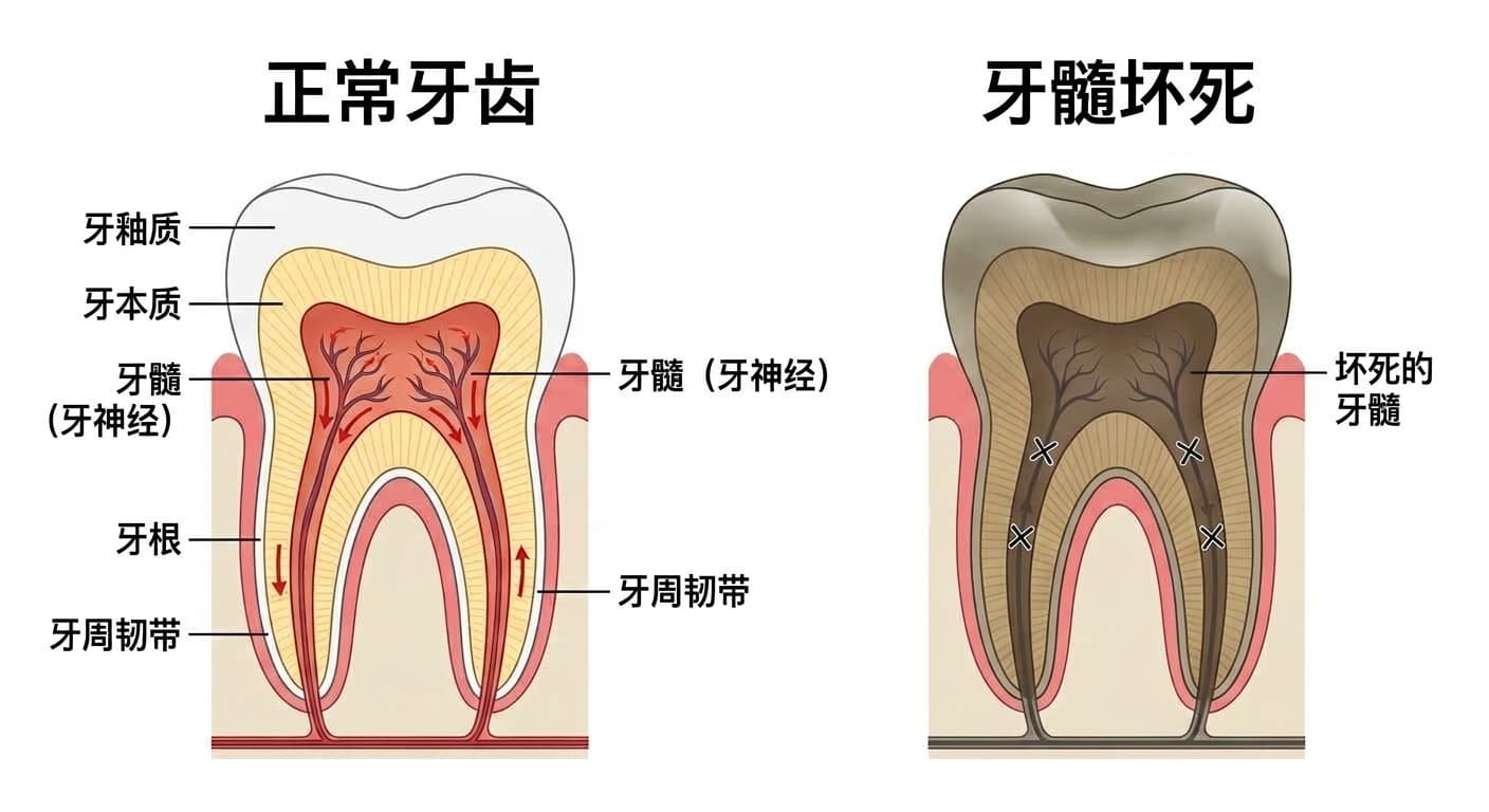 正常牙齿与牙髓坏死牙齿的剖面对比。正常牙齿的牙髓中有血液流动，而牙髓坏死的牙齿血流中断，牙髓呈灰色坏死