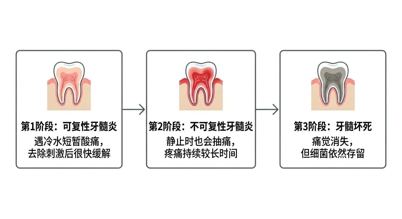 牙髓炎的进展阶段流程图。第1阶段可复性牙髓炎（遇冷水短暂酸痛，去除刺激后很快缓解）、第2阶段不可复性牙髓炎（静止时也会抽痛，疼痛持续较长时间）、第3阶段牙髓坏死（痛觉消失，但细菌依然存留）依次演进