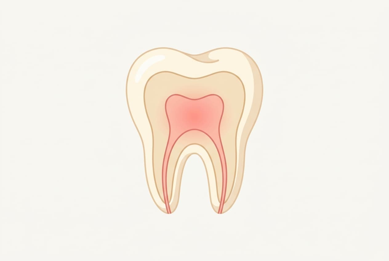 Pulpitis (Nerve Inflammation)