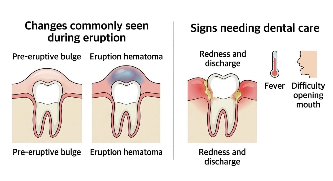 A comparison of changes commonly seen during eruption (pre-eruptive bulge, eruption hematoma) with signs of infection that need dental care (redness and discharge, fever, difficulty opening the mouth)