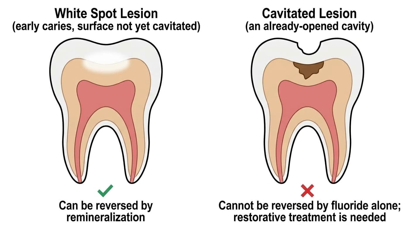 A cross-section diagram of a molar comparing a white spot lesion, early caries that has not yet cavitated, with a cavitated lesion, a cavity that has already opened up. The white spot lesion on the left has a smooth, unbroken surface and a green checkmark noting it can be reversed by remineralization; the cavitated lesion on the right has a surface that has caved in with brown decay reaching the dentin, and a red X noting it cannot be reversed by fluoride alone.