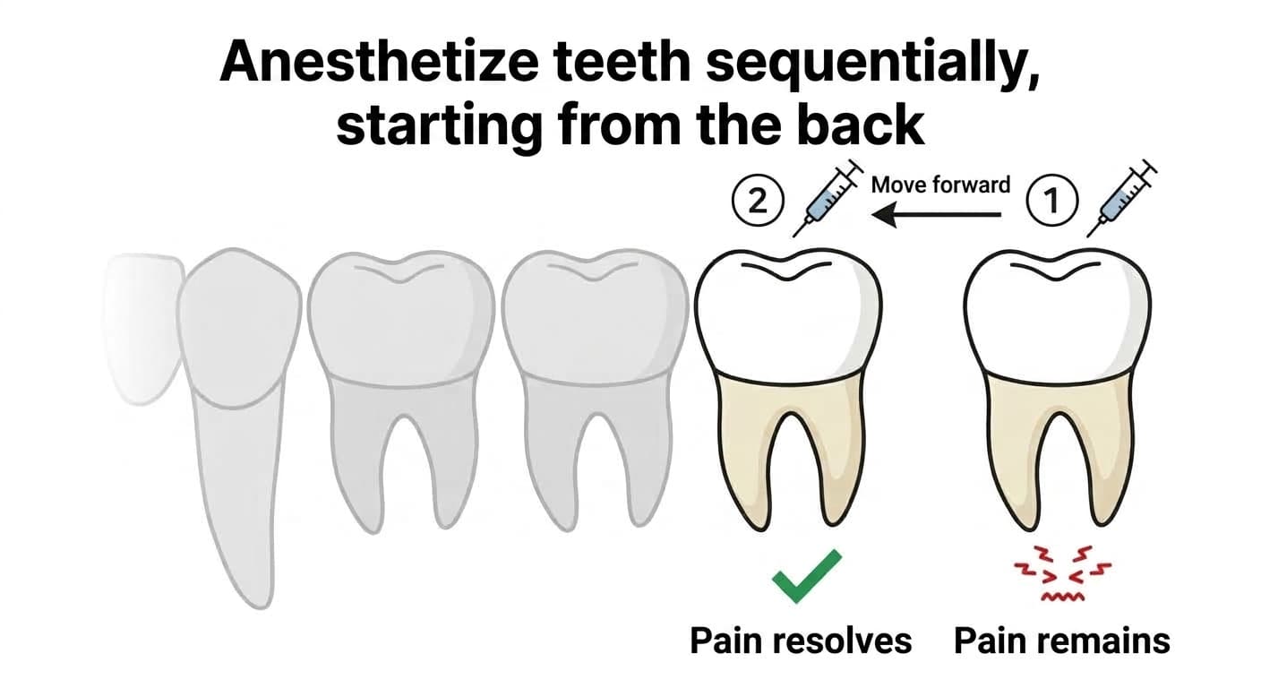 Diagram of the anesthetic test: anesthetizing teeth in order from the back to find the tooth where the pain disappears