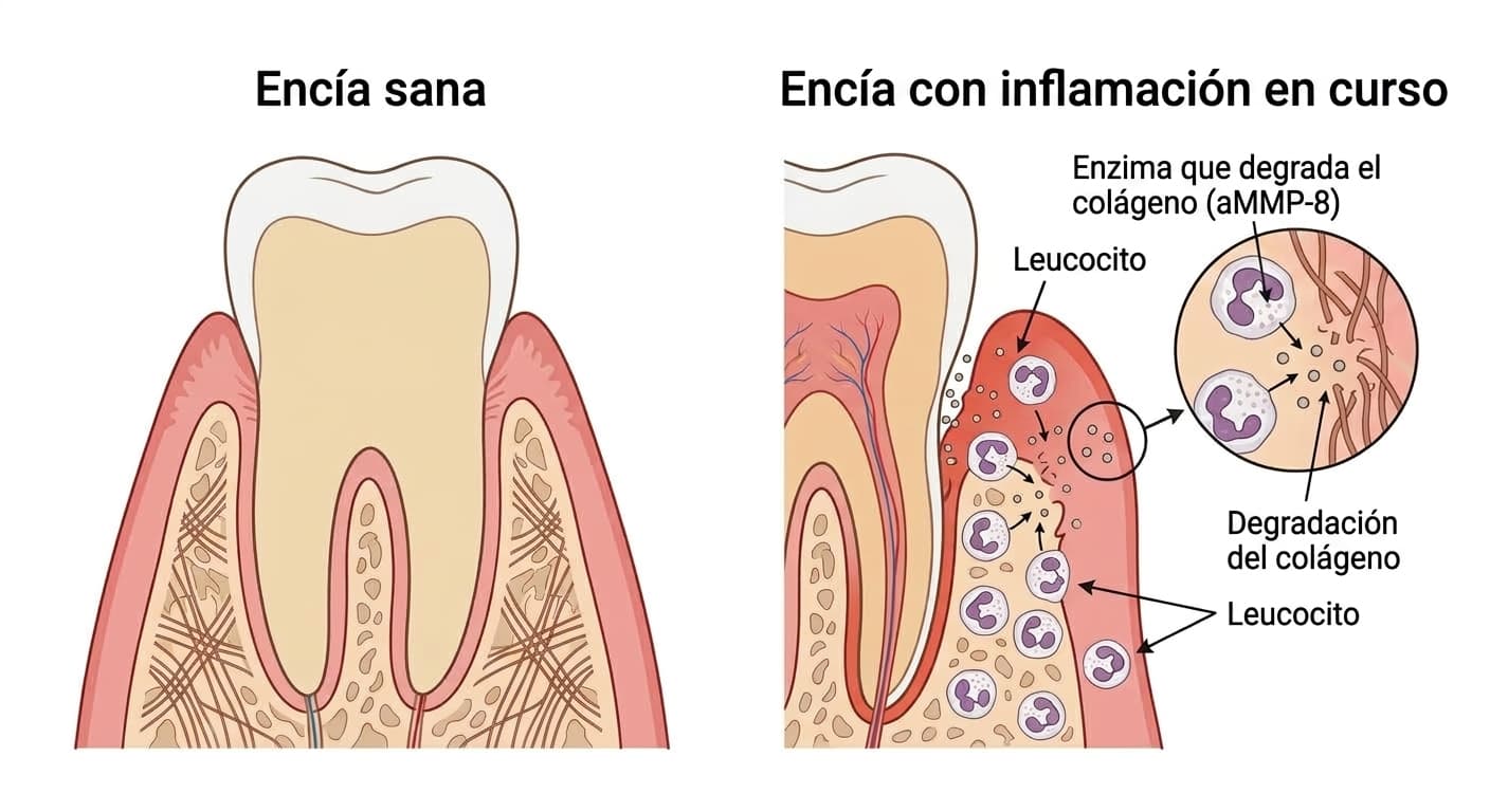 Corte transversal que compara la liberación de la enzima que degrada el colágeno (aMMP-8) por los leucocitos en una encía sana y en una encía con inflamación en curso
