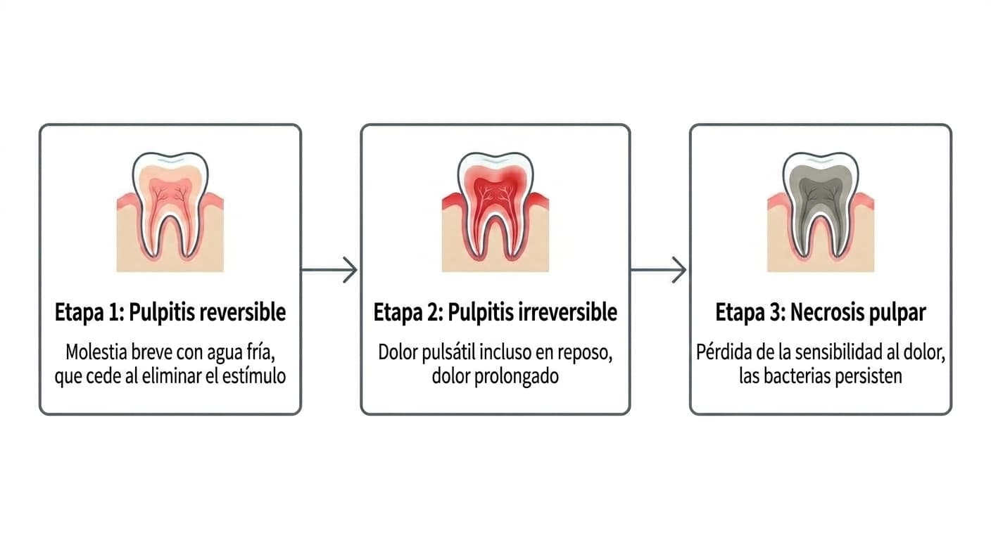 Etapas de progresión de la pulpitis. Diagrama de flujo: Etapa 1, pulpitis reversible (molestia breve con agua fría, que cede al eliminar el estímulo); Etapa 2, pulpitis irreversible (dolor pulsátil incluso en reposo, dolor prolongado); Etapa 3, necrosis pulpar (pérdida de la sensibilidad al dolor, las bacterias persisten)
