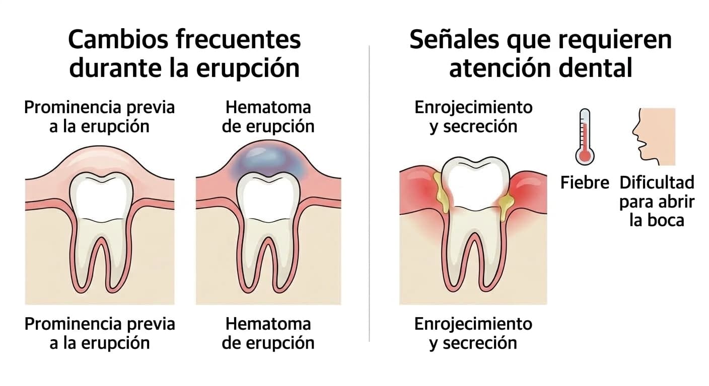 Ilustración que compara los cambios frecuentes durante la erupción (prominencia previa a la erupción, hematoma de erupción) con las señales de infección que requieren atención dental (enrojecimiento y secreción, fiebre, dificultad para abrir la boca)