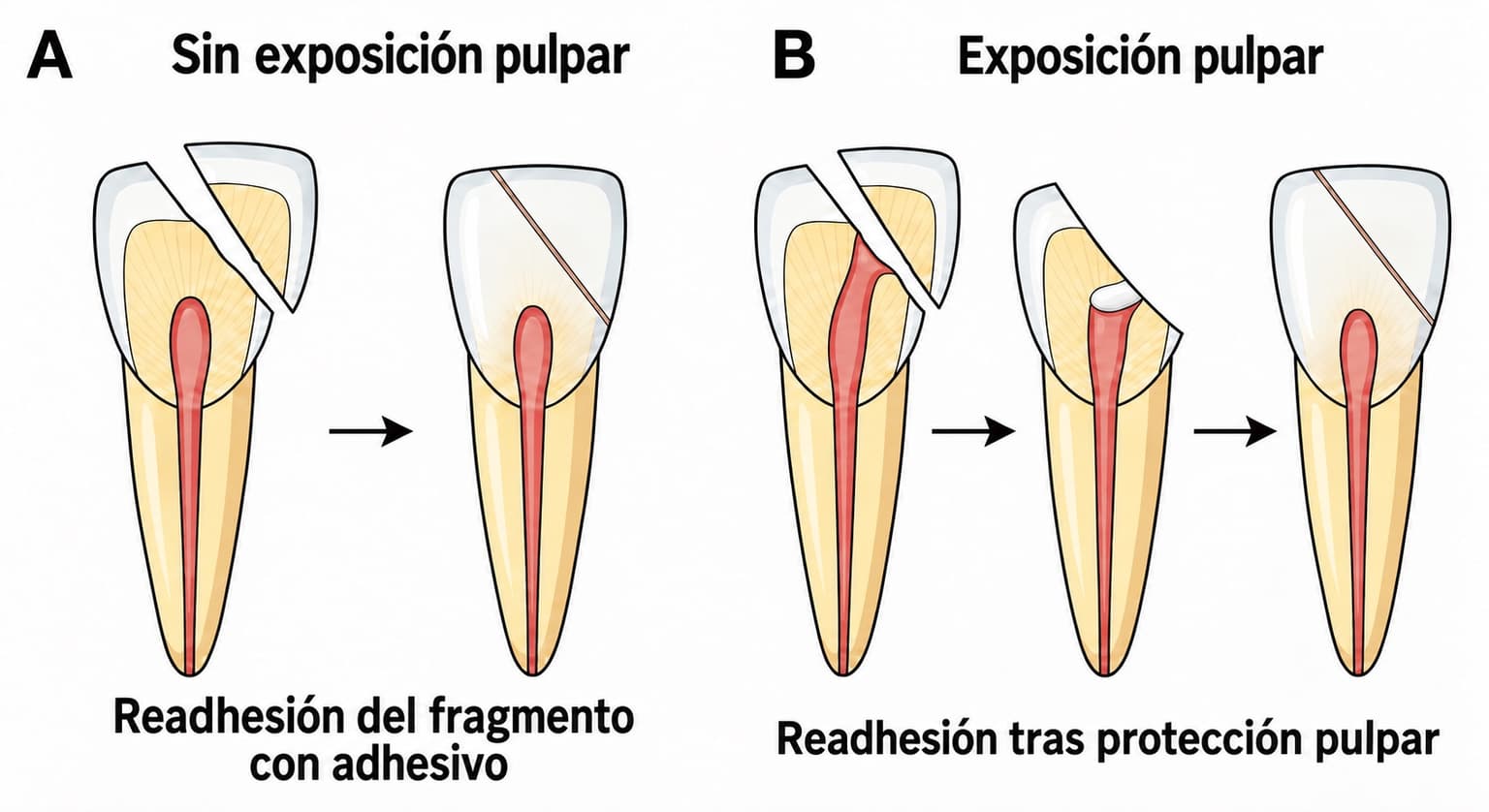 Ilustración que compara la reinserción del fragmento de un incisivo superior según haya o no exposición del nervio. A muestra el proceso sin exposición del nervio, en el que el fragmento se reinserta directamente con adhesivo; B muestra el proceso con exposición del nervio, en el que primero se coloca un material protector y luego se reinserta el fragmento.