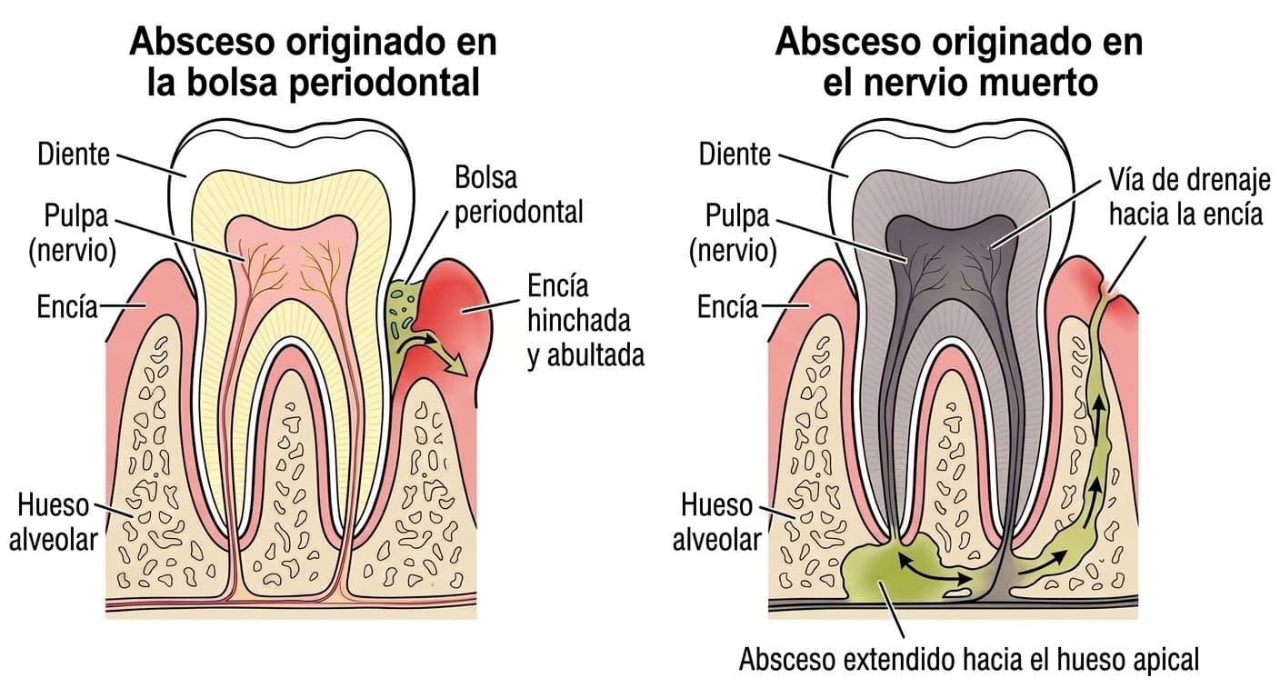 Esquema en sección de un diente que compara el absceso originado en la bolsa periodontal con el originado en un nervio muerto