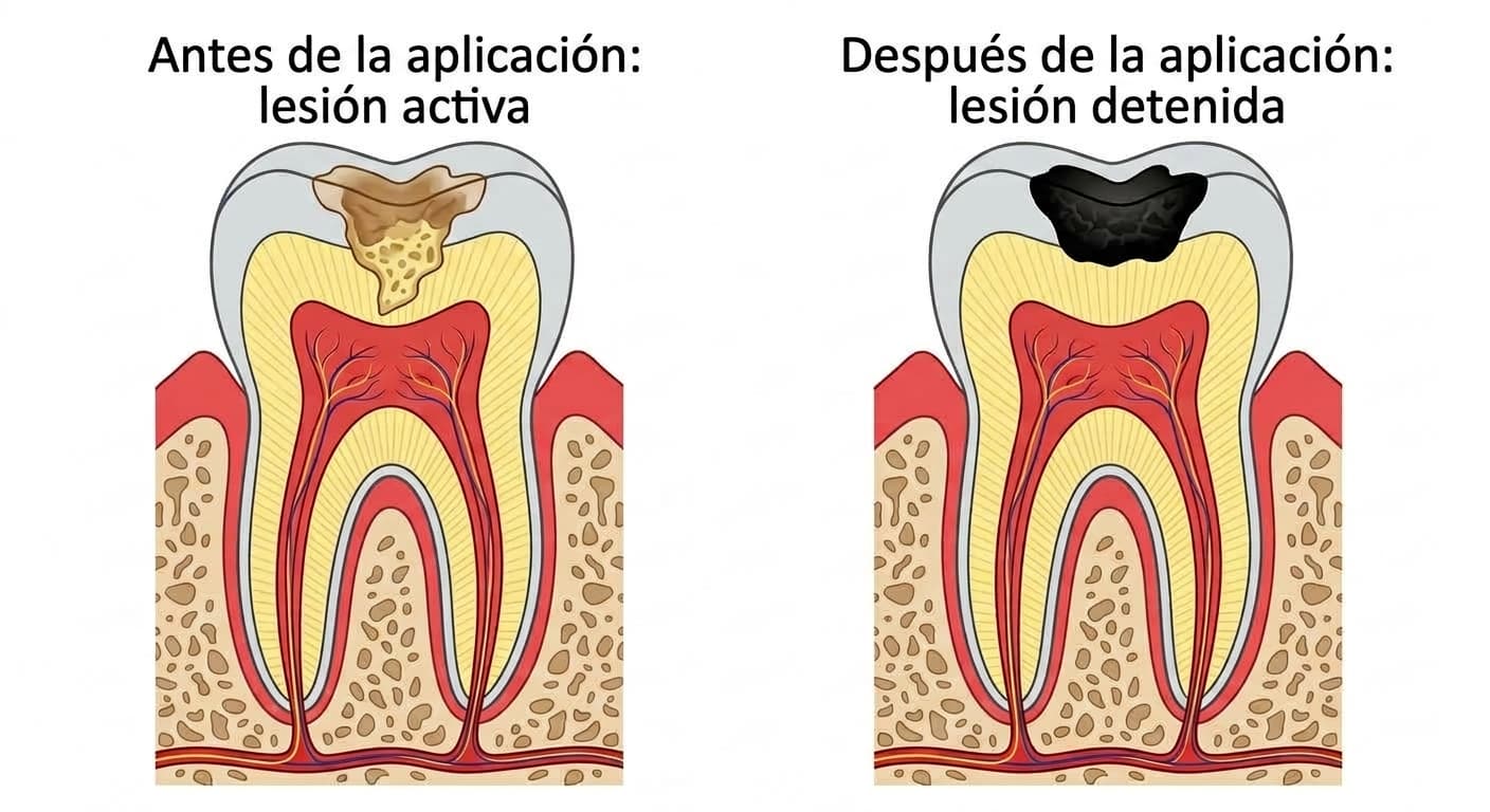 Corte transversal de un diente que compara la lesión de caries antes y después de dos aplicaciones de SDF. Antes de la aplicación se observa una lesión ablandada de color pardo; después, una lesión endurecida y ennegrecida.