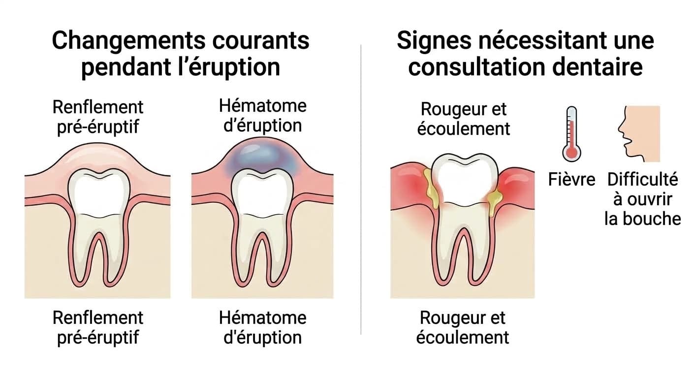 Illustration comparant les changements courants pendant la période d'éruption (renflement pré-éruptif, hématome d'éruption) et les signes d'infection nécessitant une consultation dentaire (rougeur et écoulement, fièvre, difficulté à ouvrir la bouche)