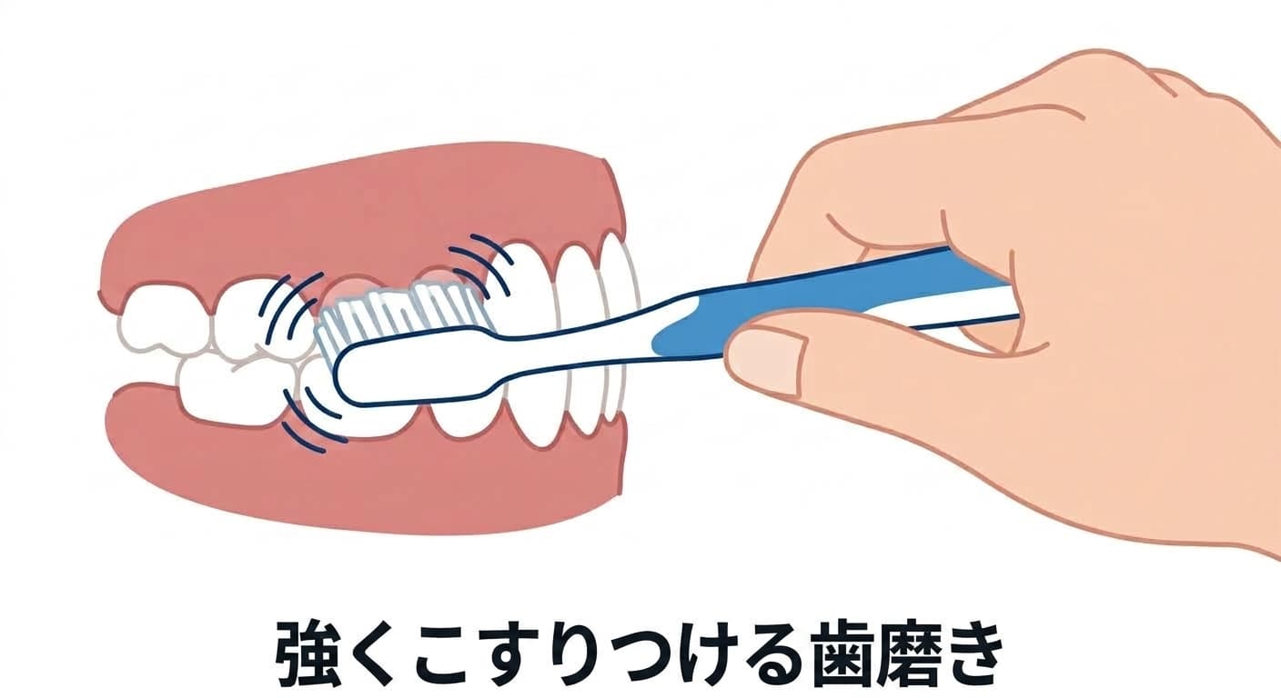 強くこすりつける歯磨きによって歯の首の部分に繰り返し摩擦が加わる様子