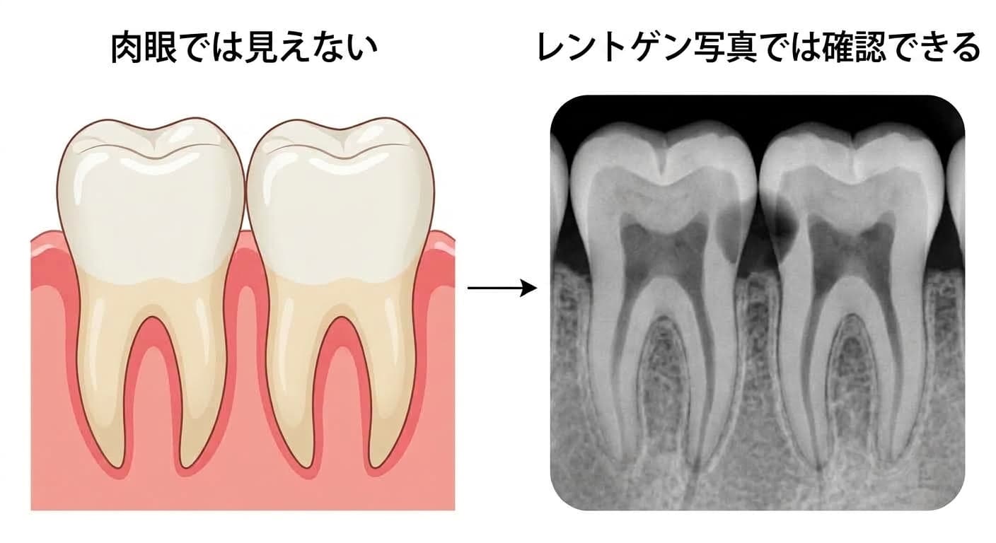 歯と歯の間(隣接面)のう蝕は肉眼では見えないが、レントゲン写真では黒く現れる様子を比較した図