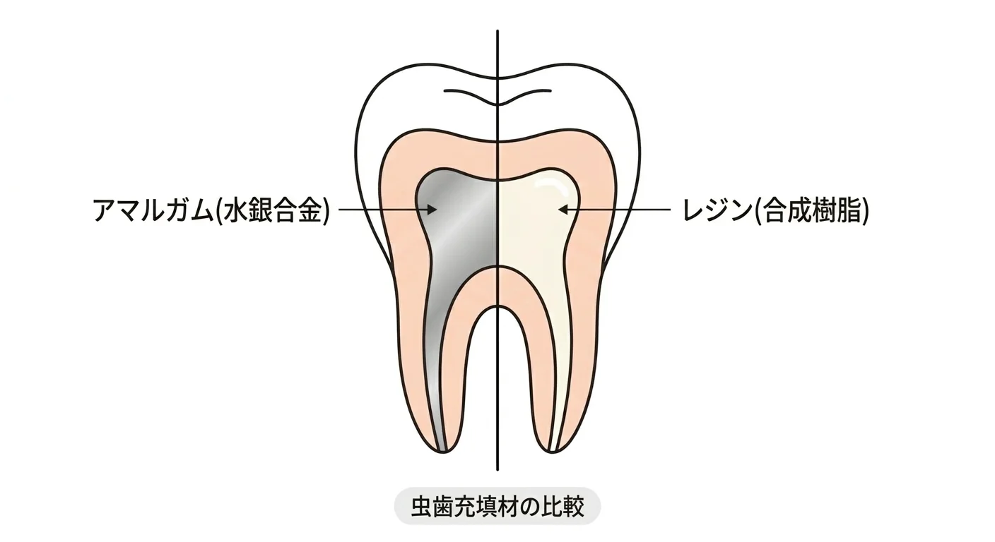 虫歯の部分をそれぞれアマルガムとレジンで詰めた歯の断面を並べて比較した図