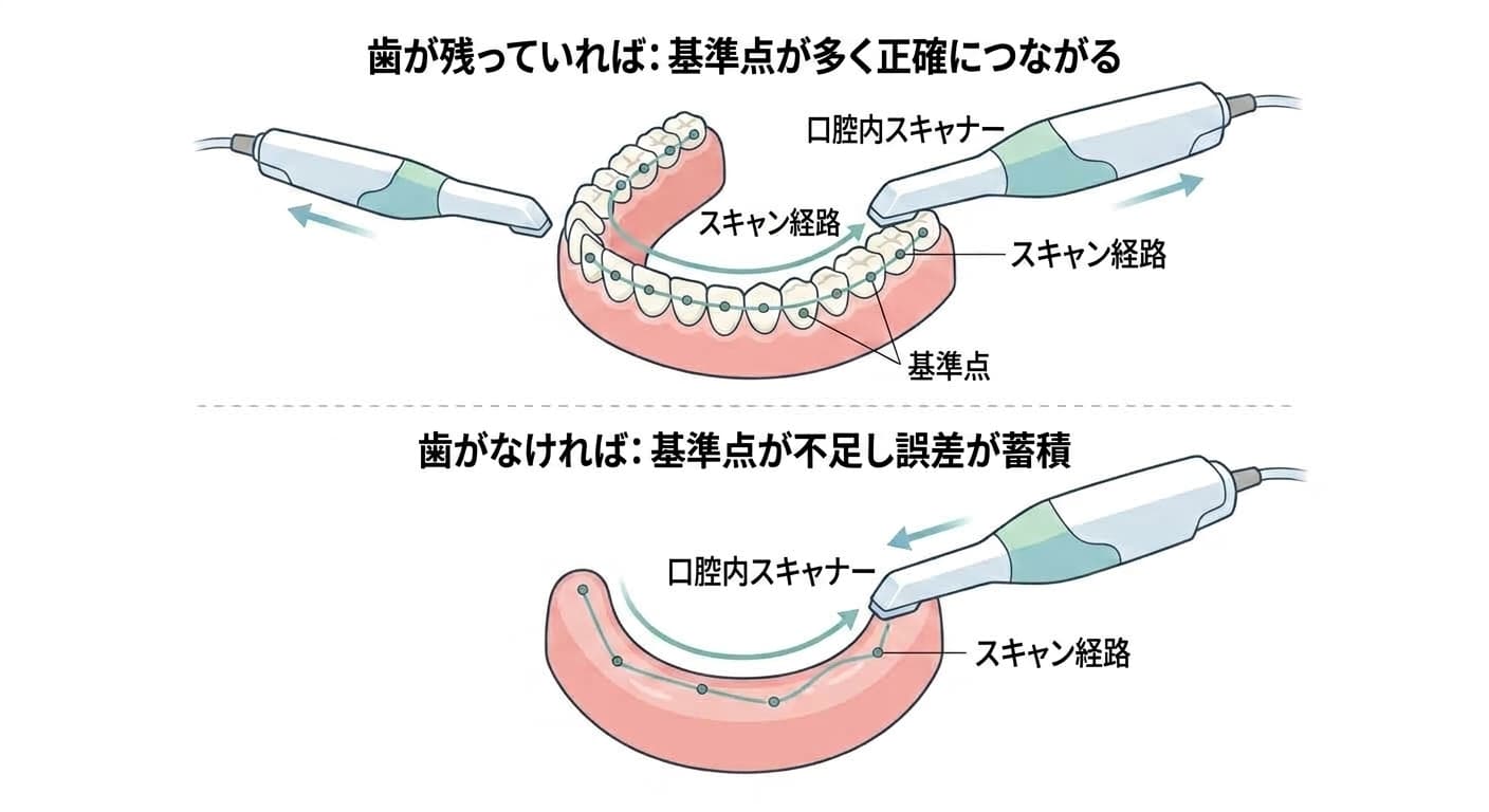 歯が残っているときとないときで、口腔内スキャナーのスキャン経路が基準点に沿ってつながる方式がどのように異なるかを比較した図