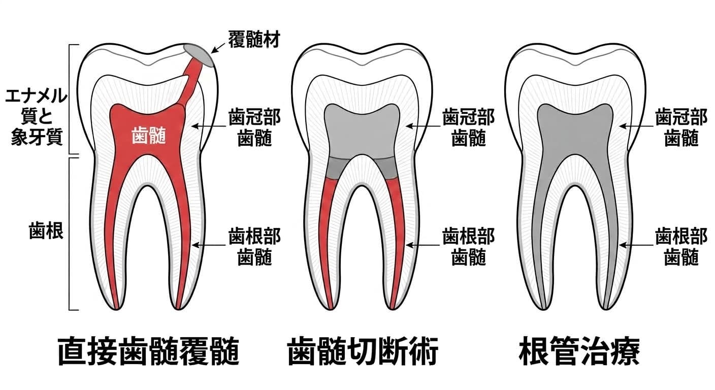 直接歯髄覆髄、歯髄切断術、根管治療で残す、または除去する歯髄範囲を比較した歯の断面図