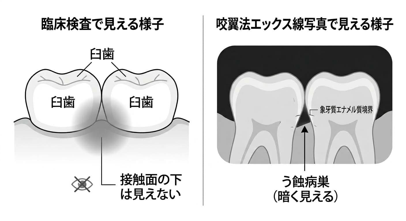 歯と歯の接触面の下は臨床検査では隠れて見えないが、咬翼法エックス線写真では象牙質エナメル質境界付近に暗いう蝕病巣として現れることを比較した図