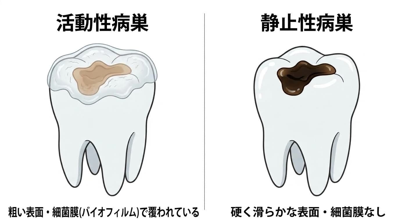 咬合面にできた活動性病巣と静止性病巣の比較。活動性病巣は粗い表面に細菌膜(バイオフィルム)が覆っており、静止性病巣は硬く滑らかな濃い色の表面を示す。