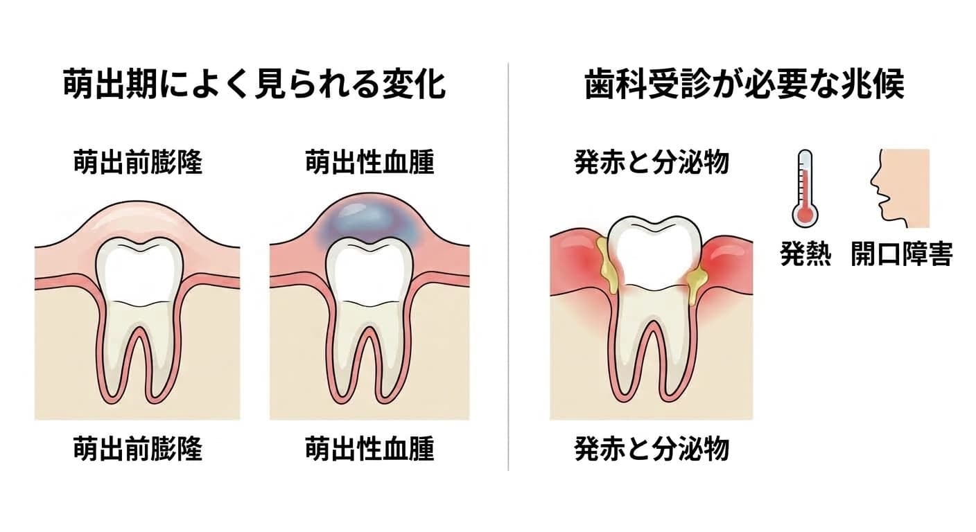 萌出期によく見られる変化(萌出前膨隆、萌出性血腫)と、歯科受診が必要な感染の兆候(発赤と分泌物、発熱、開口障害)を比較した図