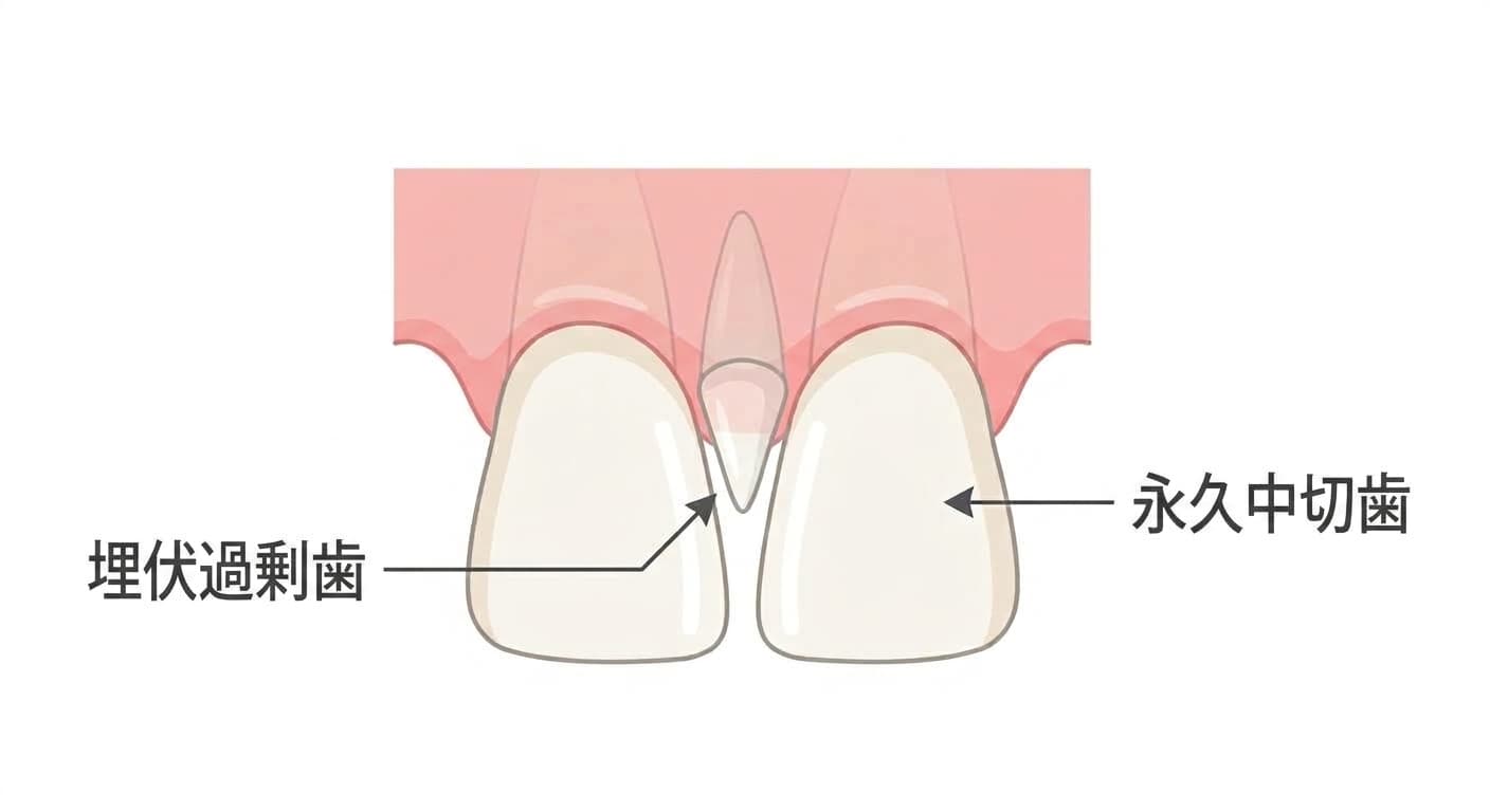 上の前歯2本の間の歯茎の中に逆さまに埋まった円錐形の過剰歯を示す正中過剰歯の概念図
