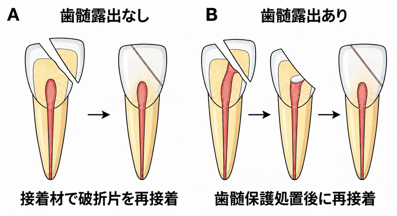 上顎前歯の破折片再接着を歯髄露出の有無で比較した図。Aは歯髄露出がなく接着剤で破片をそのまま再接着する過程を、Bは歯髄が露出しており保護材で覆ってから破片を再接着する過程を示す。