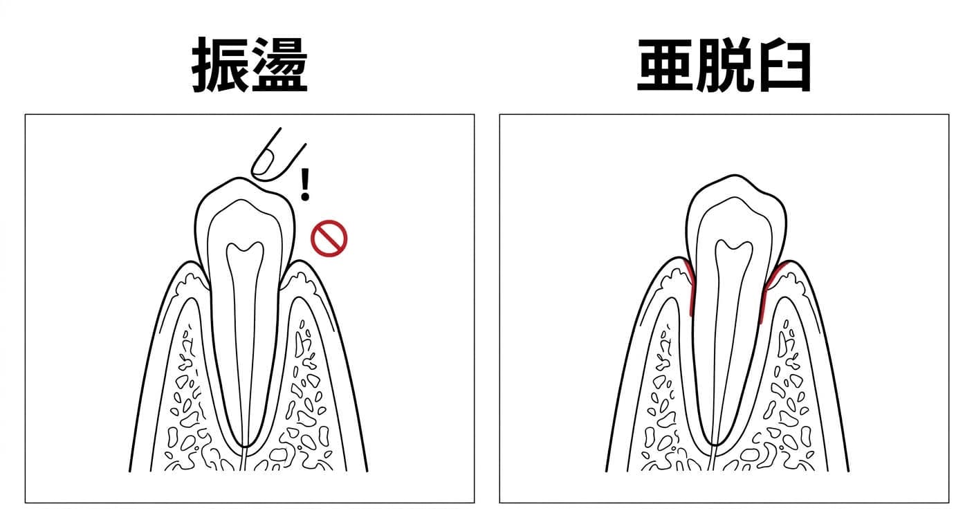 振盪と亜脱臼を比較した図。振盪は叩いたときに過敏だが動揺の兆候はなく、亜脱臼は歯肉辺縁に出血が見られる