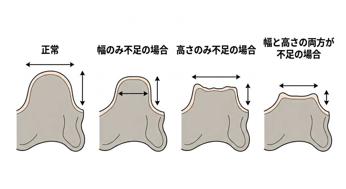正常な歯槽骨と、幅のみ不足している場合、高さのみ不足している場合、幅と高さの両方が不足している場合を並べて比較した図