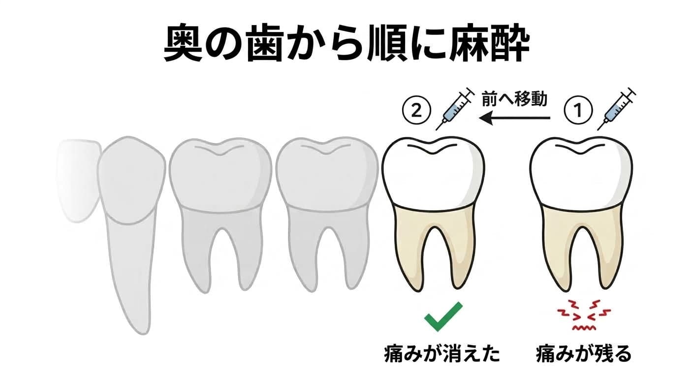 奥の歯から順に麻酔して痛みが消える歯を探す麻酔検査の概念図