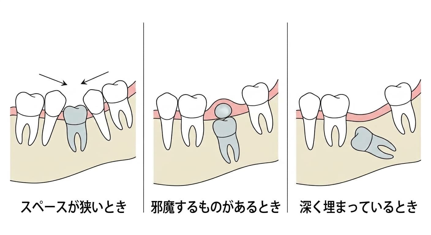 永久歯が遅れて生えてくるときに確認する3つのケースを比較した図。スペースが狭いとき、塞いでいるものがあるとき、深く埋まっているとき(埋伏)