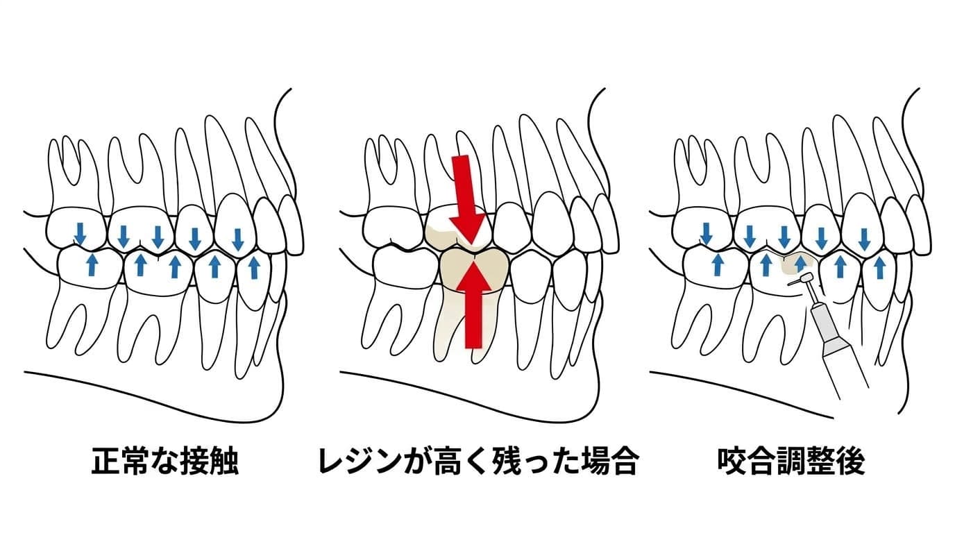 正常な接触、レジンが高く残った場合、咬合調整後に力が均等に分散する様子を比較した図