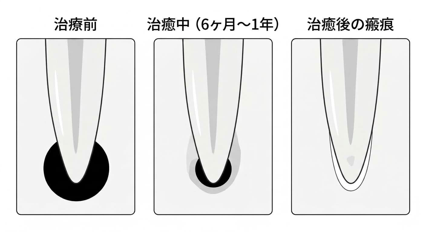 治療前に根尖に明瞭な病変があった状態から、治癒中の経過を経て、治癒後は小さな瘢痕だけが残る過程を示す3段階の比較図