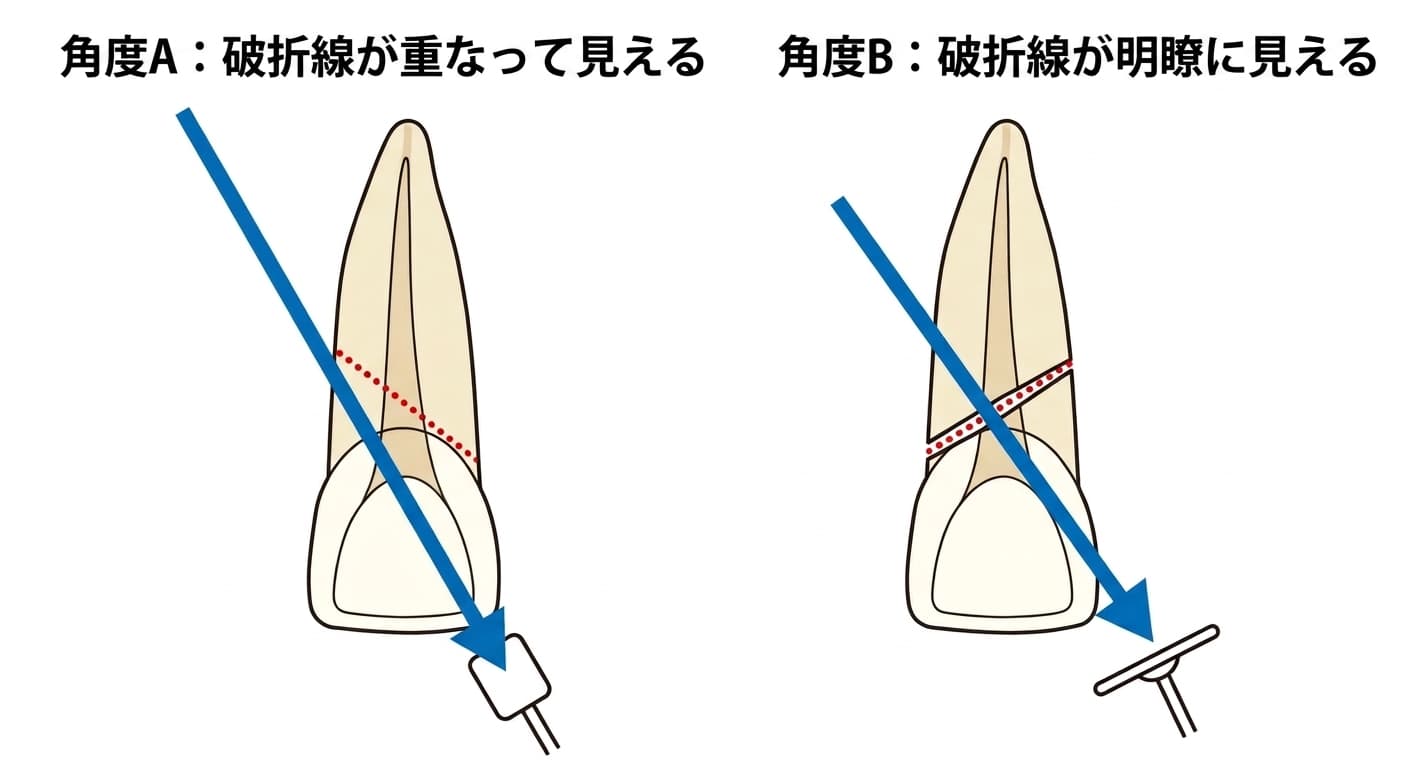 レントゲンの撮影角度によって斜めに生じた歯根破折線が重なって見えたり、はっきり見えたりする様子を比較した図