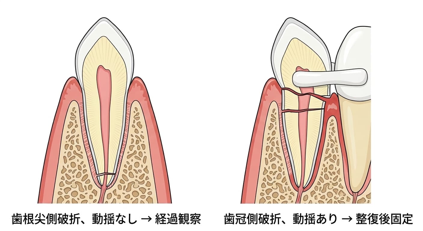 歯根破折の位置が根の先端側か歯冠側かによって治療が変わることを比較した図