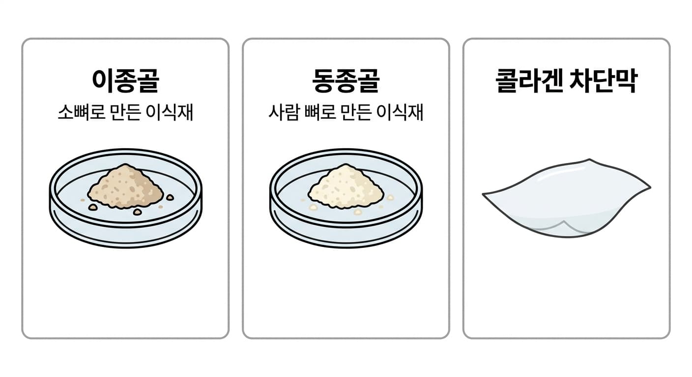 소뼈에서 만든 이종골 입자, 사람 뼈에서 만든 동종골 입자, 콜라겐 차단막을 나란히 놓고 각 재료의 역할을 보여주는 그림