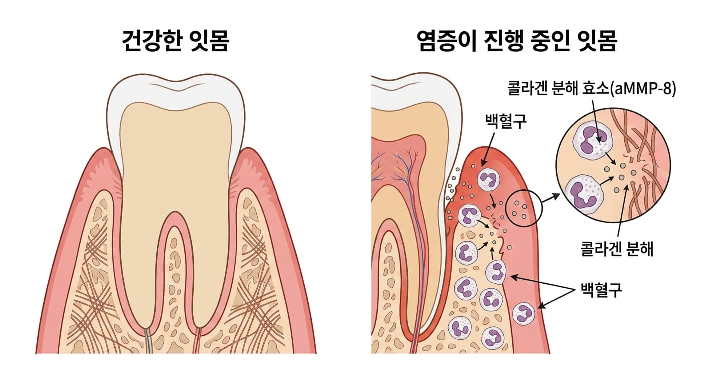 건강한 잇몸과 염증이 진행 중인 잇몸에서 백혈구가 콜라겐 분해 효소(aMMP-8)를 방출하는 과정을 비교한 단면도