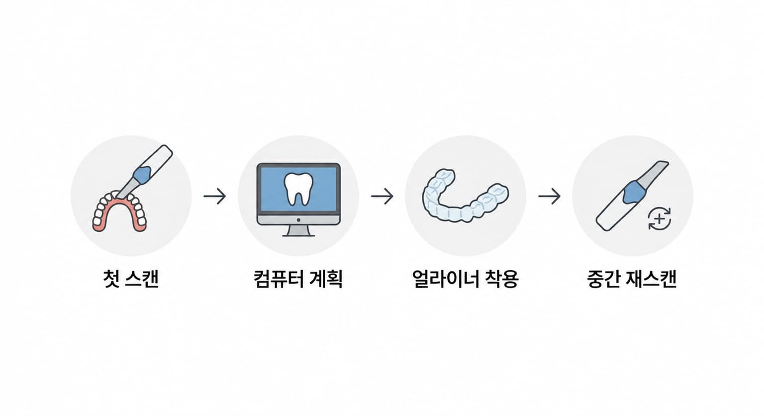 스캔, 컴퓨터 계획, 얼라이너 착용, 중간 재스캔(리파인먼트)으로 이어지는 치료 과정 순서도
