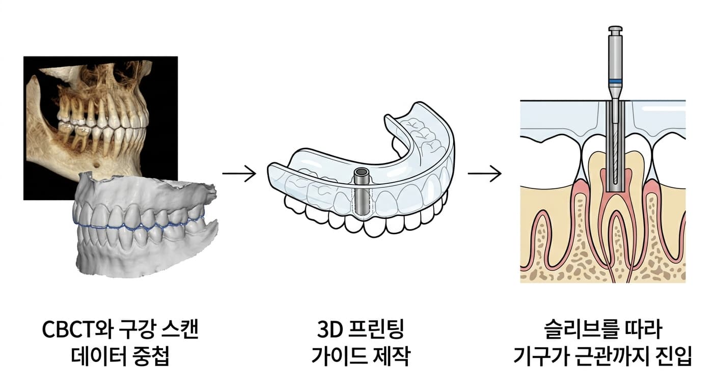 CBCT와 구강 스캔 데이터를 중첩해 3D 프린팅 가이드를 만들고, 가이드에 끼운 금속 슬리브를 따라 기구가 근관까지 진입하는 3단계 과정을 보여주는 모식도
