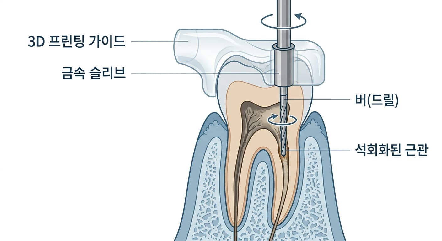 3D 프린팅 가이드에 삽입된 금속 슬리브를 따라 버가 석회화된 근관 입구까지 유도되는 모습