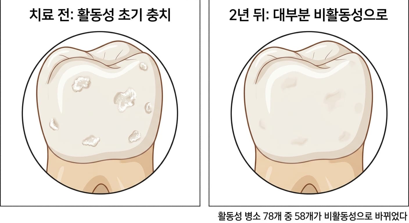 치료 전 활동성 초기 충치로 하얀 반점이 여러 개 있던 치아와 2년 뒤 반점 대부분이 옅어진 같은 치아를 비교한 그림