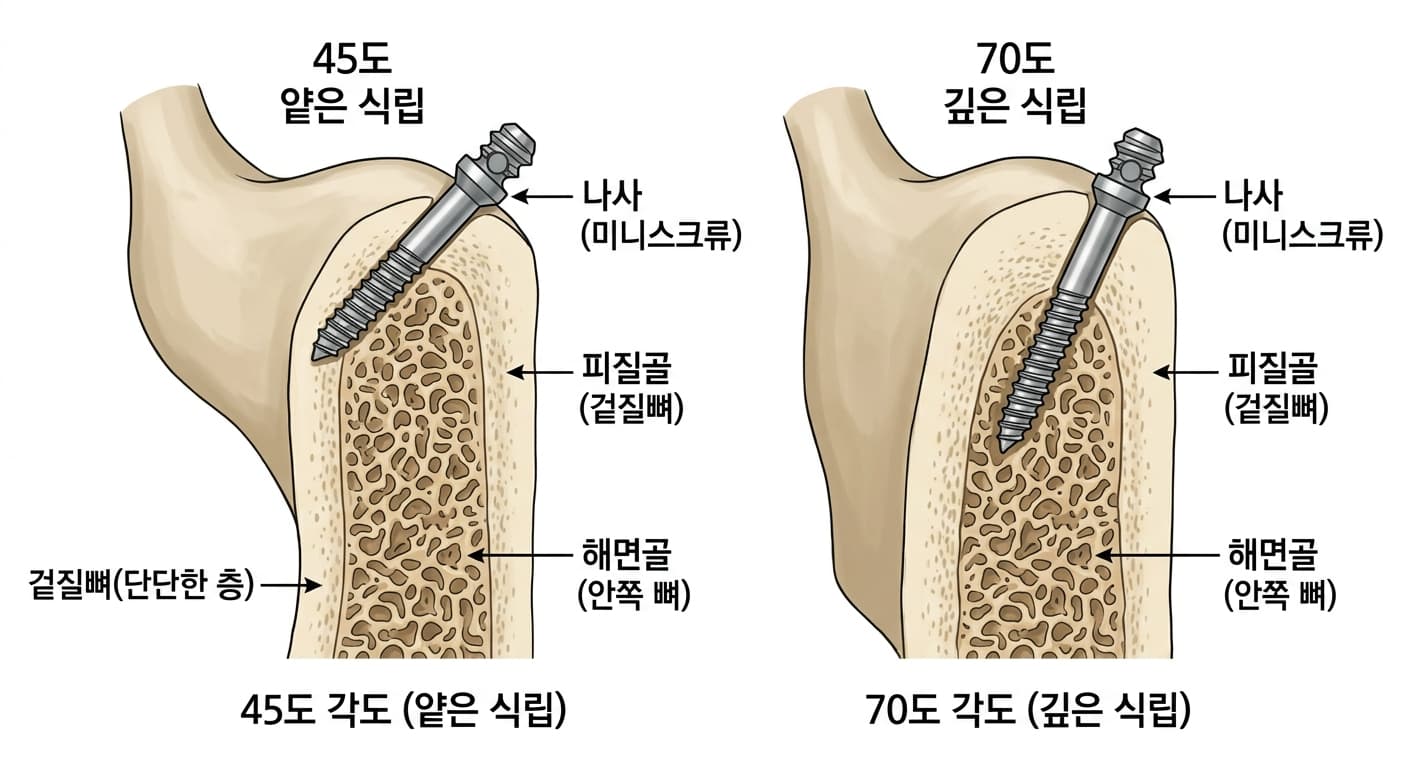 같은 잇몸뼈에 나사를 45도와 70도로 각각 비스듬히 심어 70도로 심은 나사가 더 두꺼운 겉질 뼈층을 파고드는 모습을 비교하는 도해