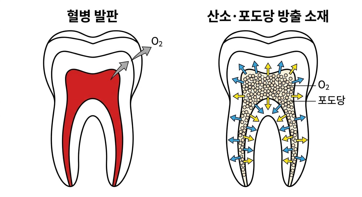기존 재생 근관치료의 혈병 발판과, 뿌리관 전체에 산소·포도당을 고르게 퍼뜨리는 새 소재를 비교한 치아 단면 모식도