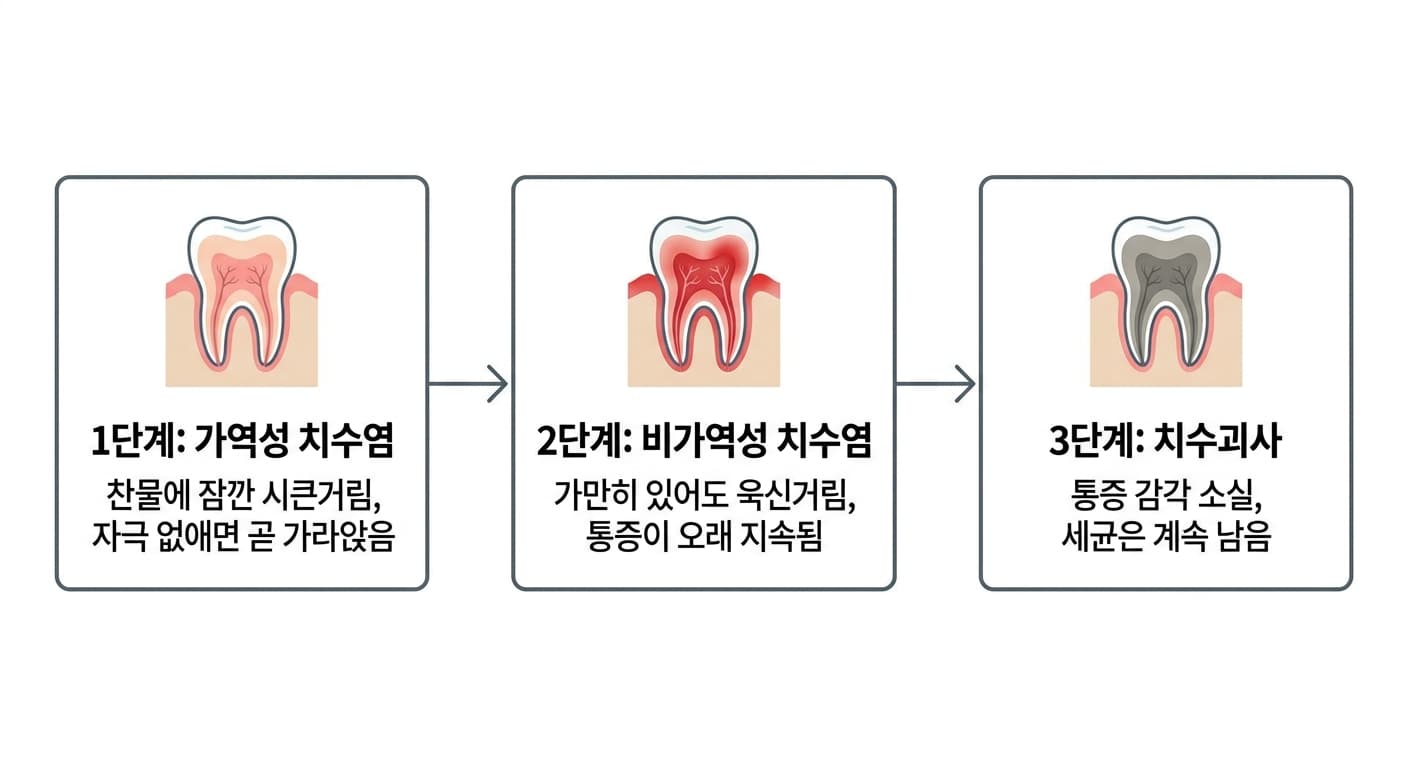 치수염의 진행 단계. 1단계 가역성 치수염(찬물에 잠깐 시큰거림, 자극 없애면 곧 가라앉음), 2단계 비가역성 치수염(가만히 있어도 욱신거림, 통증이 오래 지속됨), 3단계 치수괴사(통증 감각 소실, 세균은 계속 남음)로 이어지는 흐름도