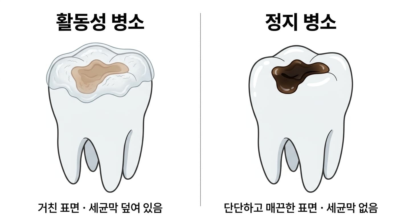씹는 면에 생긴 활동성 병소와 정지 병소의 비교. 활동성 병소는 거친 표면에 세균막이 덮여 있고, 정지 병소는 단단하고 매끈한 짙은 색 표면을 보인다.