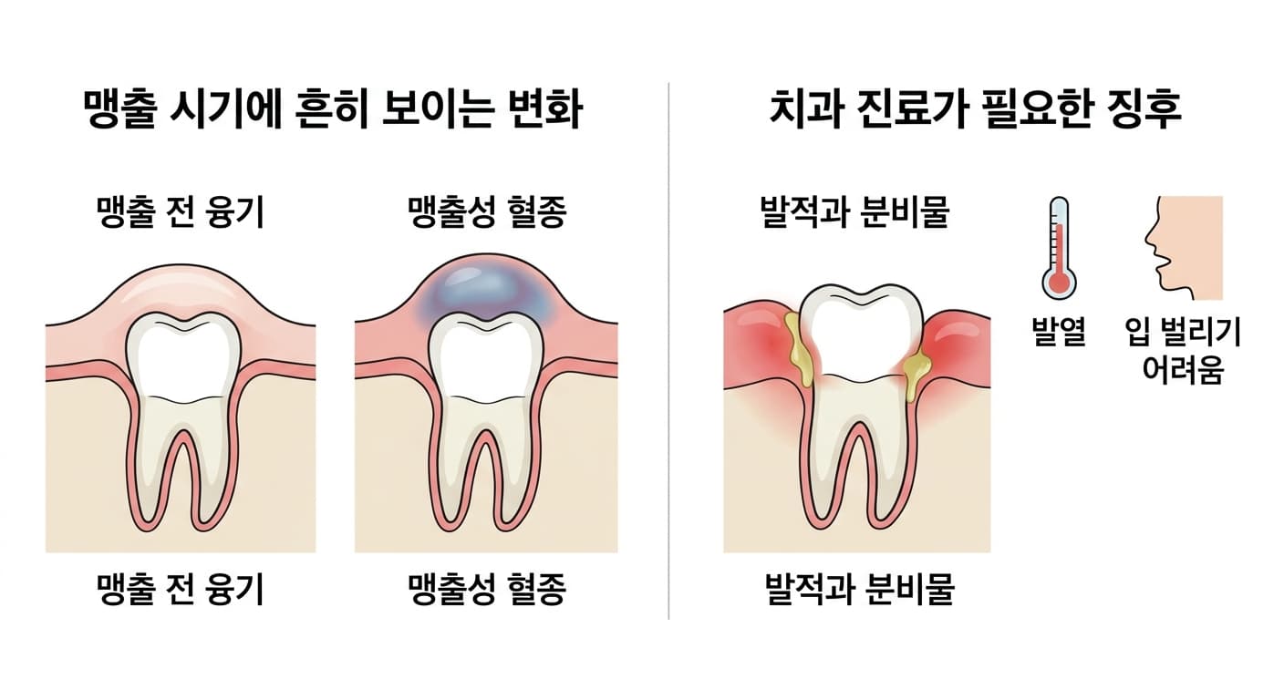 맹출 시기에 흔히 보이는 변화(맹출 전 융기, 맹출성 혈종)와 치과 진료가 필요한 감염 징후(발적과 분비물, 발열, 입 벌리기 어려움)를 비교한 그림