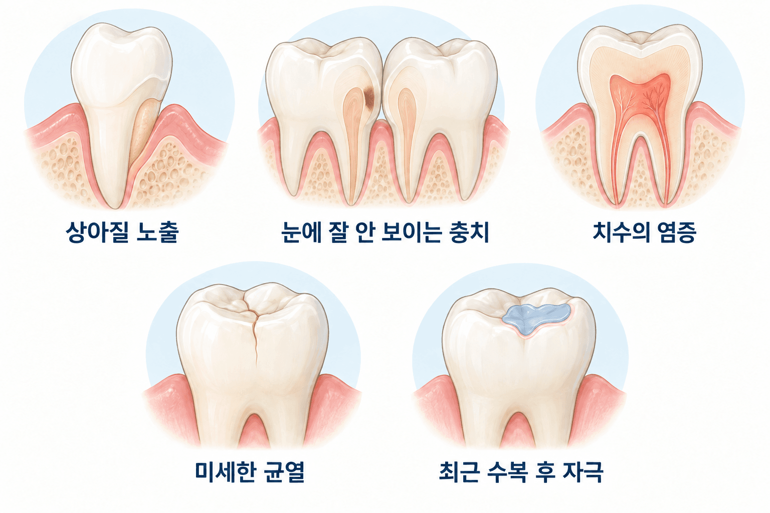 상아질 노출, 눈에 잘 안 보이는 충치, 치수의 염증, 미세한 균열, 최근 수복 후 자극을 비교한 그림