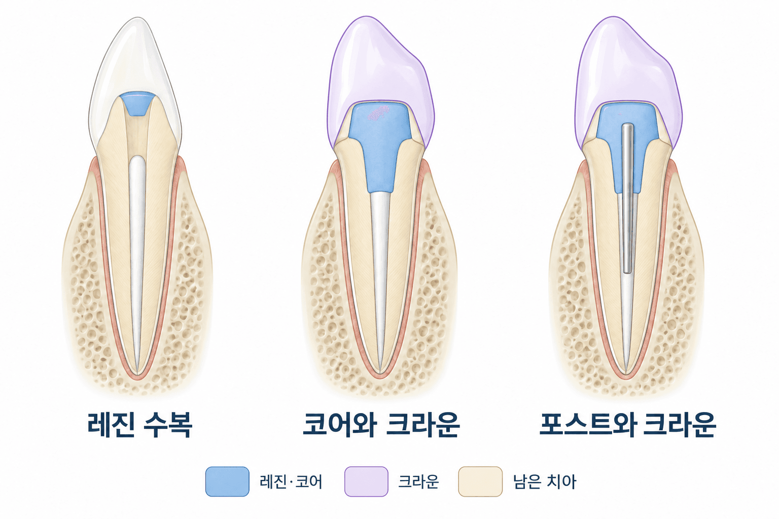 신경치료한 앞니의 레진 수복, 코어와 크라운, 포스트와 크라운을 비교한 그림
