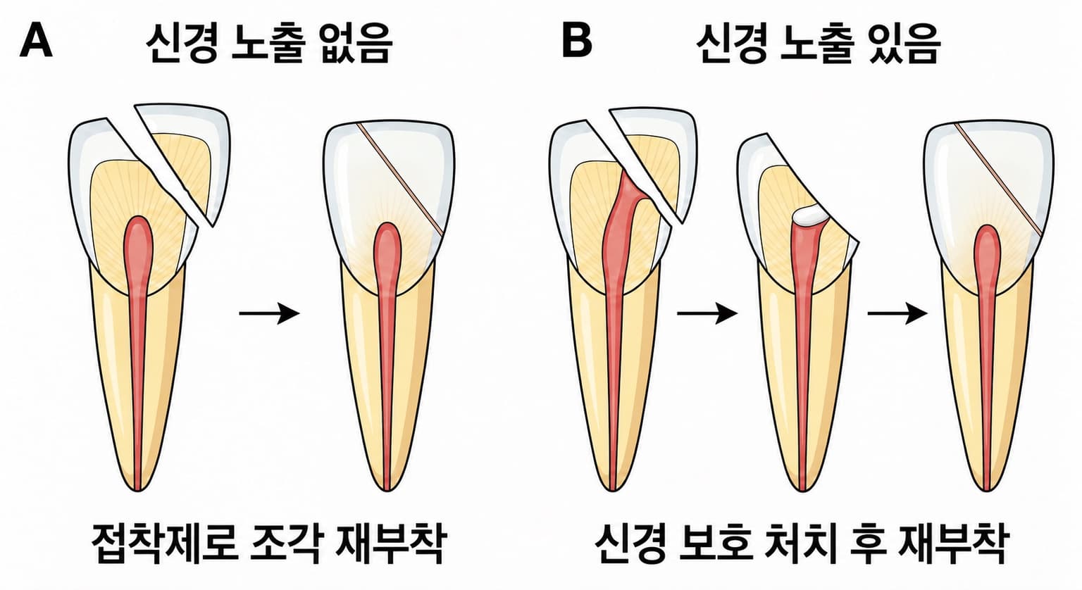 위턱 앞니 파절편 재부착을 신경 노출 여부로 비교한 그림. A는 신경 노출이 없어 접착제로 조각을 바로 재부착하는 과정을, B는 신경이 노출되어 보호재를 덮은 뒤 조각을 재부착하는 과정을 보여준다.