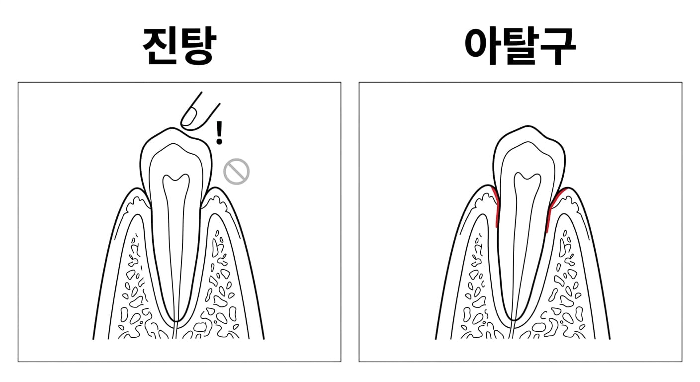 진탕과 아탈구를 비교한 그림. 진탕은 두드릴 때 민감하지만 흔들림 표시가 없고, 아탈구는 잇몸 가장자리에 출혈이 나타난다