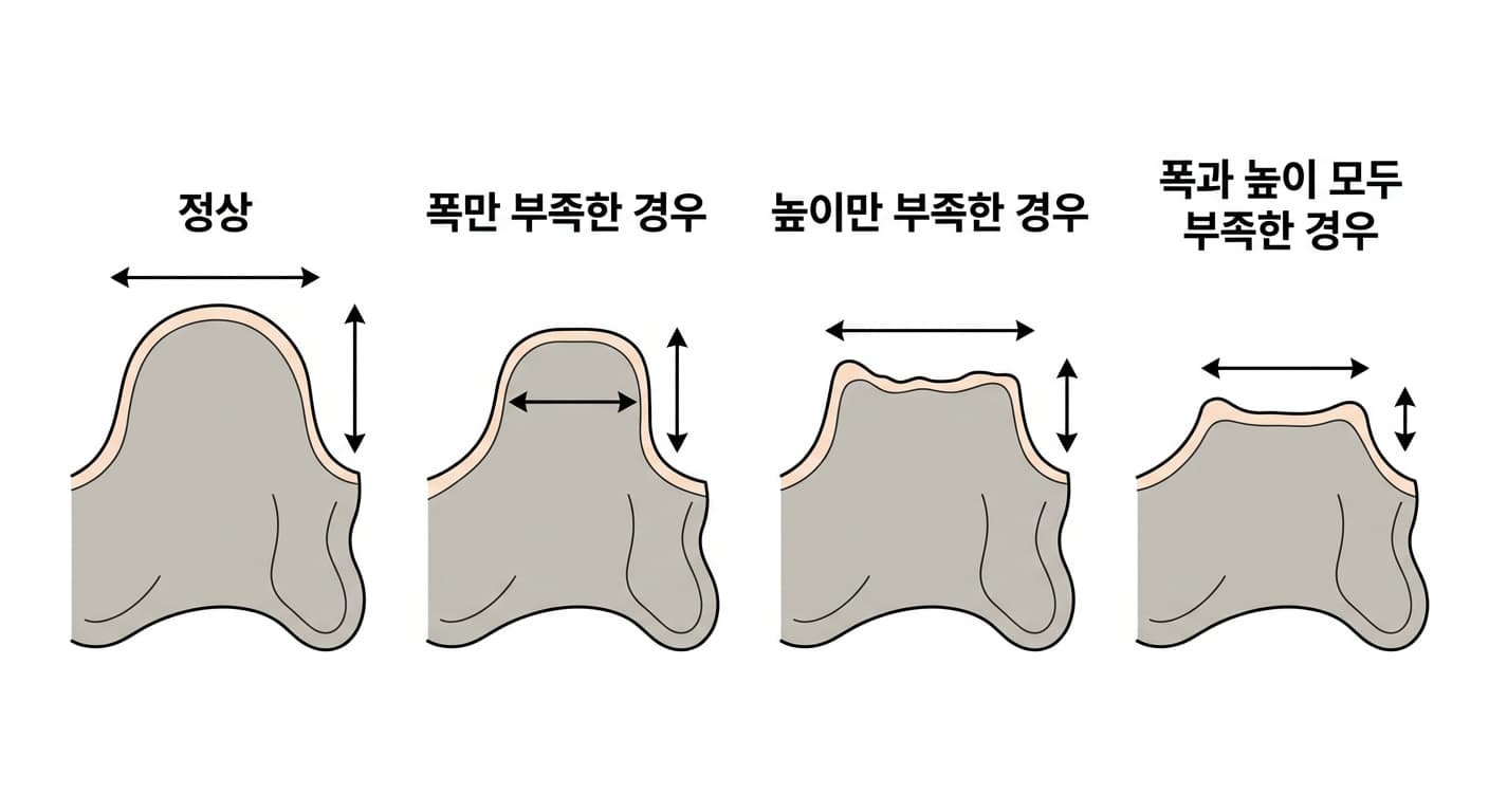 정상 치조골과 폭만 부족한 경우, 높이만 부족한 경우, 폭과 높이가 함께 부족한 경우를 나란히 비교한 그림