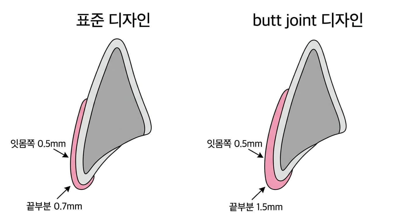 라미네이트 절단면 디자인에 따른 삭제 두께 비교. 표준 디자인은 잇몸쪽 0.5mm, 끝부분 0.7mm를 삭제하고, butt joint 디자인은 잇몸쪽 0.5mm, 끝부분 1.5mm를 삭제한다