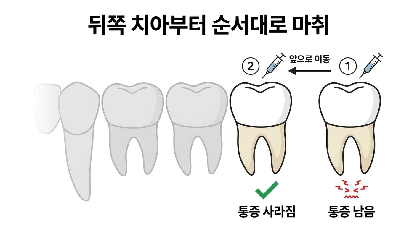 뒤쪽 치아부터 순서대로 마취해 통증이 사라지는 치아를 찾는 마취 검사 개념도